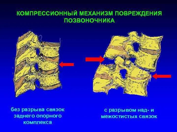 Компрессионные переломы тел позвонков механизм травмы. Сгибательный механизм травмы позвоночника. Компрессионный перелом позвонка механизм травмы. Механизмы травмы при переломах позвоночника.