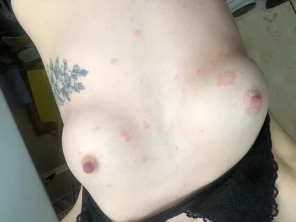 Красные пятна (розовый лишай?) фото 4.