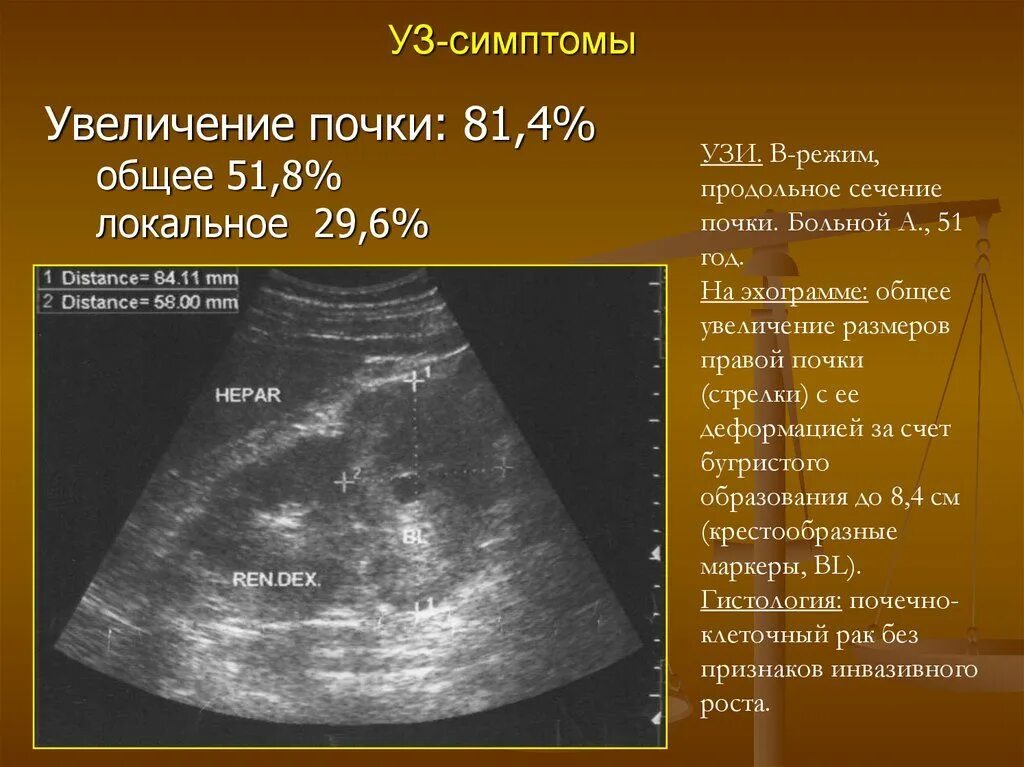 Изменение левой почки. УЗИ почек. Увеличение размеров почек. Увеличение размеров почек на УЗИ.