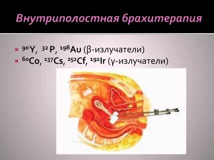 Брахитерапия шейки матки