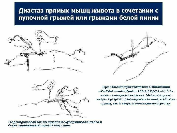 Операция диастаз прямых мышц. Диастаз прямых мышц живота кт. Пупочная грыжа упражнения. Упражнения при диастазе мышц живота. Пупочная грыжа у взрослых код по мкб