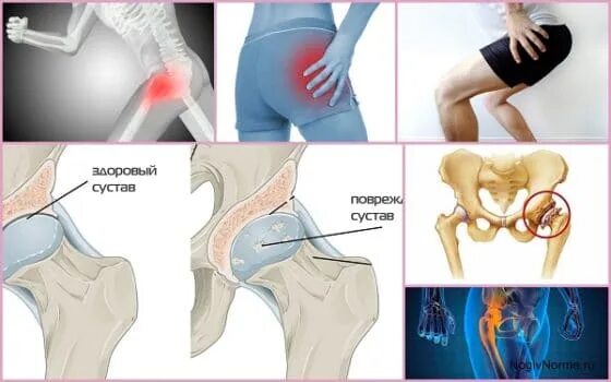 Тазобедренный сустав. Тазобедренный сустав болит. Бедренный сустав болит. Коксартроз тазобедренного сустава. Какая боль при коксартрозе