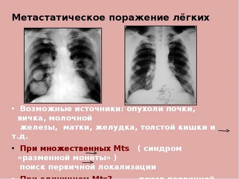 Метастазы в легких прогноз отзывы. Метастатическое поражение легких. метастатическое поражение легких рентген. метастатическое поражение легких кт.