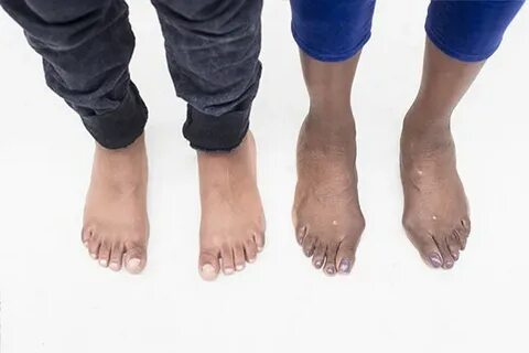 Foot collection