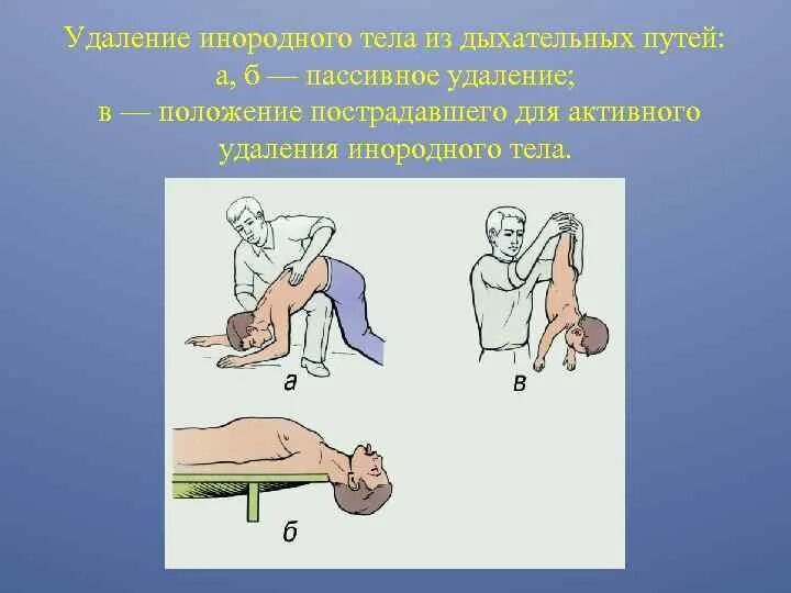 Приемы удаления инородных тел. Способы извлечения инородных тел из дыхательных путей. аспирация инородного тела в дыхательные пути. технику удаления инородного тела из дыхательных путей. извлечение инородного тела из верхних дыхательных путей.
