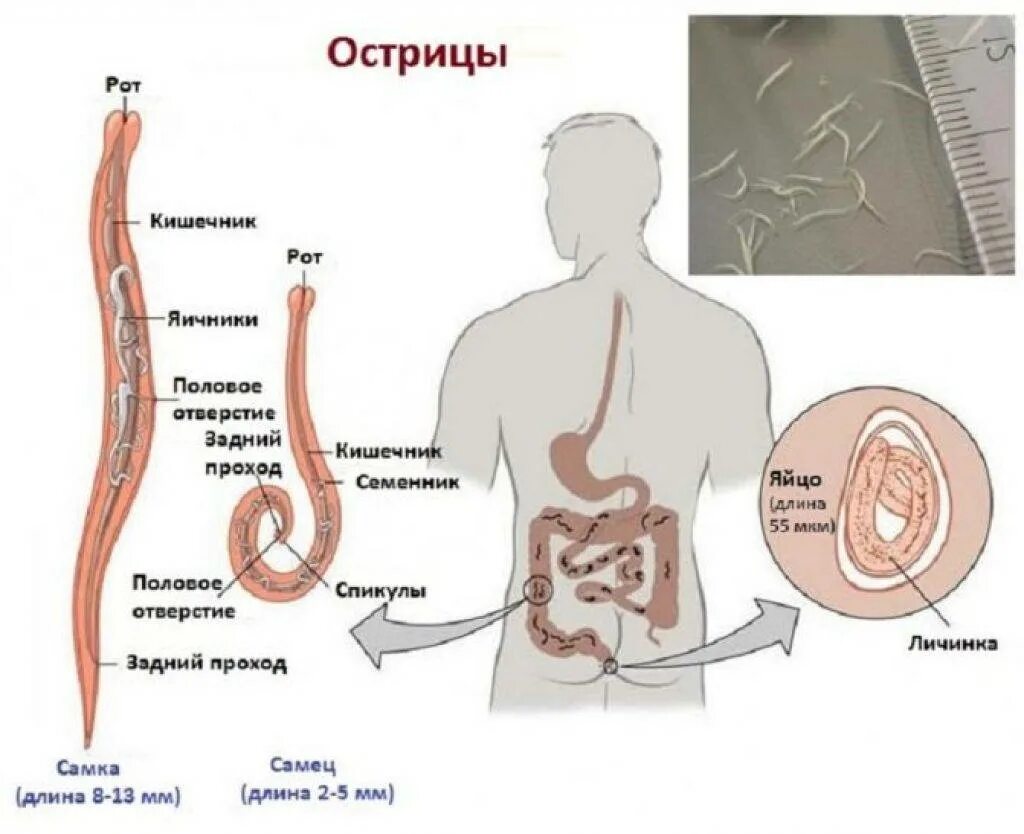 Паразиты в организме человека острицы. Гельминты энтеробиоз у детей. Строение червя Острица. Почему появляются черви