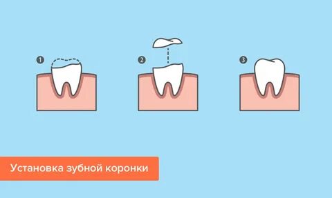 На какие зубы ставят коронки