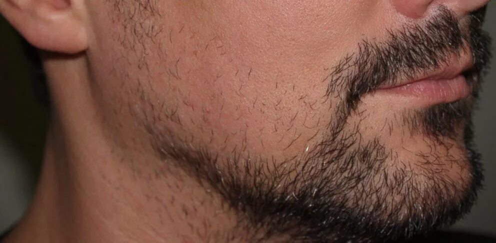 Рост волос на лице у мужчин. Неровная щетина. Редкая щетина на лице. Неравномерная щетина. Редкие волосы на бороде.