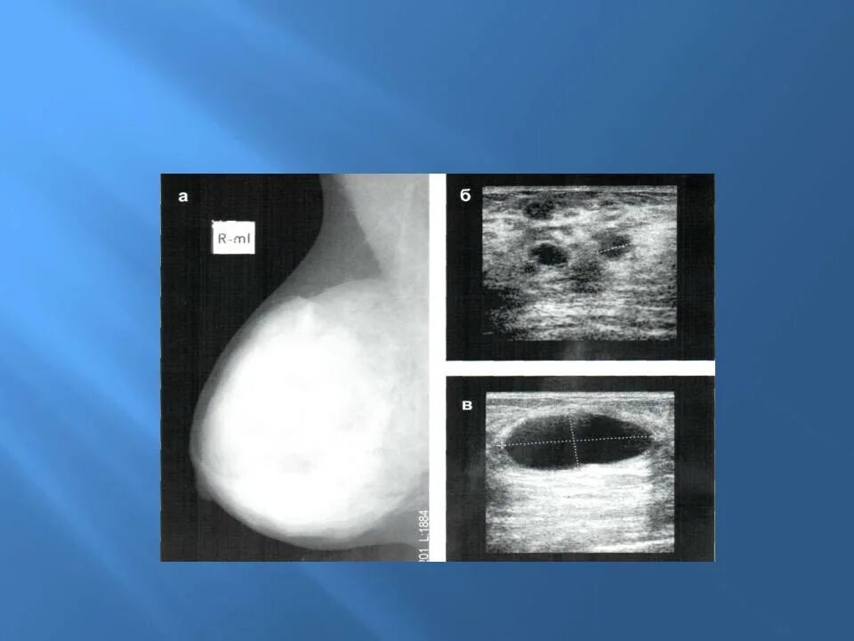 Диффузная мастопатия фиброзным компонентом. Фиброзно кистозная мастопатия молочной железы УЗИ. Узловая форма фиброзно-кистозной мастопатии. Узловая кистозная мастопатия. Фиброзная мастопатия молочной железы на УЗИ.