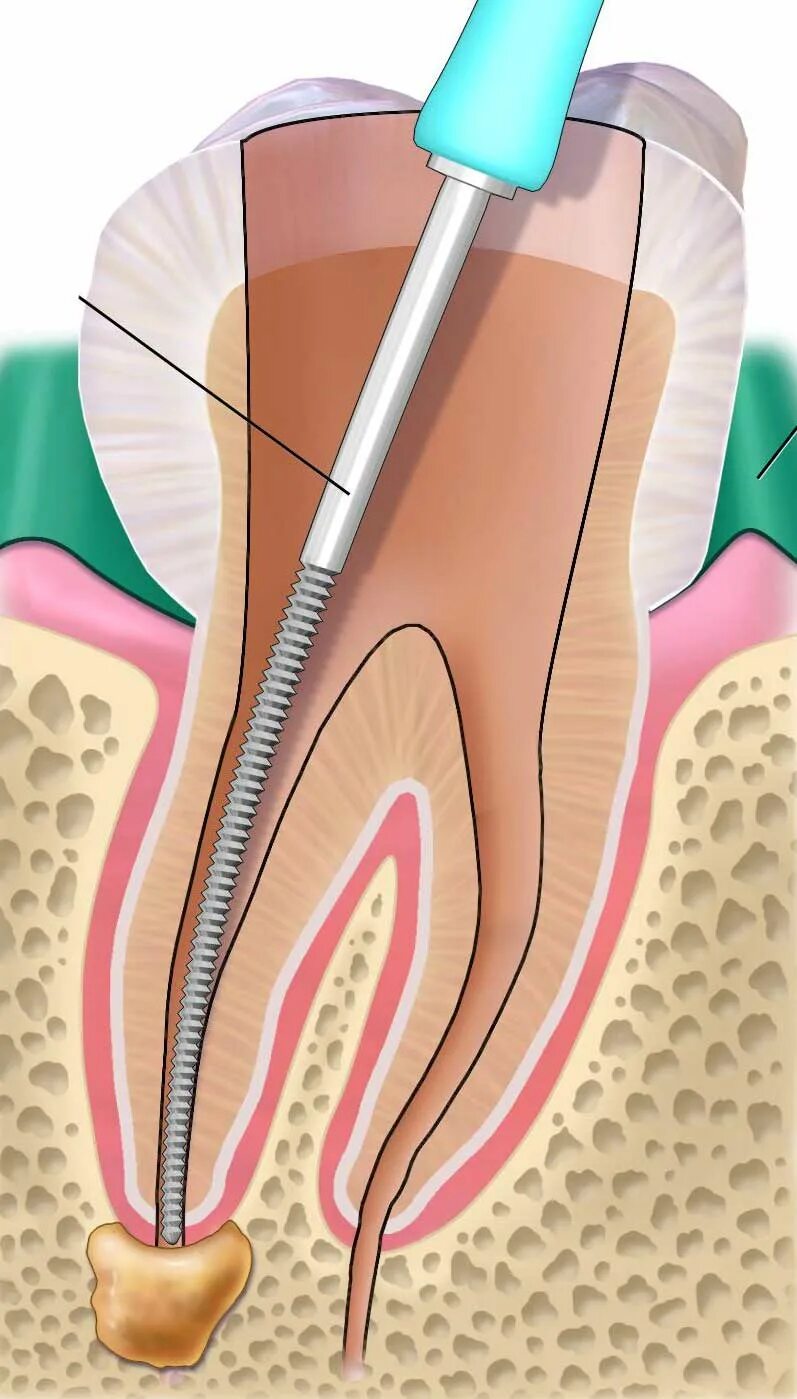 Root canal