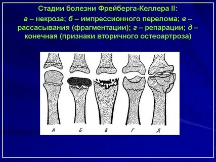 Болезнь келлера 2 степени
