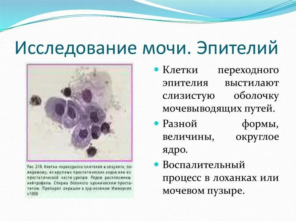 Эпителиальные клетки плоские в моче. Кубический эпителий в моче. Цитологическое исследование на атипичные клетки. Исследование мочи на атипичные клетки. Повышенный эпителий в моче у мужчин