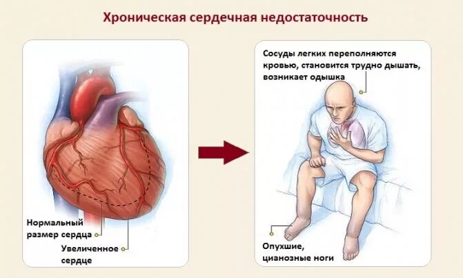 Основные признаки сердечной недостаточности. Одышка это признак сердечной недостаточности. Хроническая сердечная недостаточность жалобы пациента. Сердечная недостаточность ортопноэ. Хроническая легочно-сердечная недостаточность.