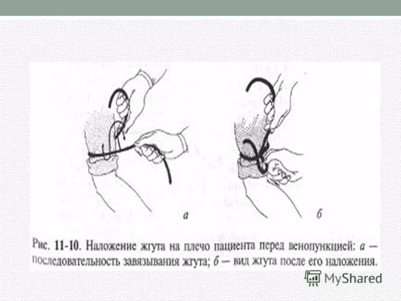 наложение венозного жгута. внутривенной инъекции жгут накладывают. введение внутривенной инъекции. внутривенное введение наложение жгута. наложение жгута при инъекции.