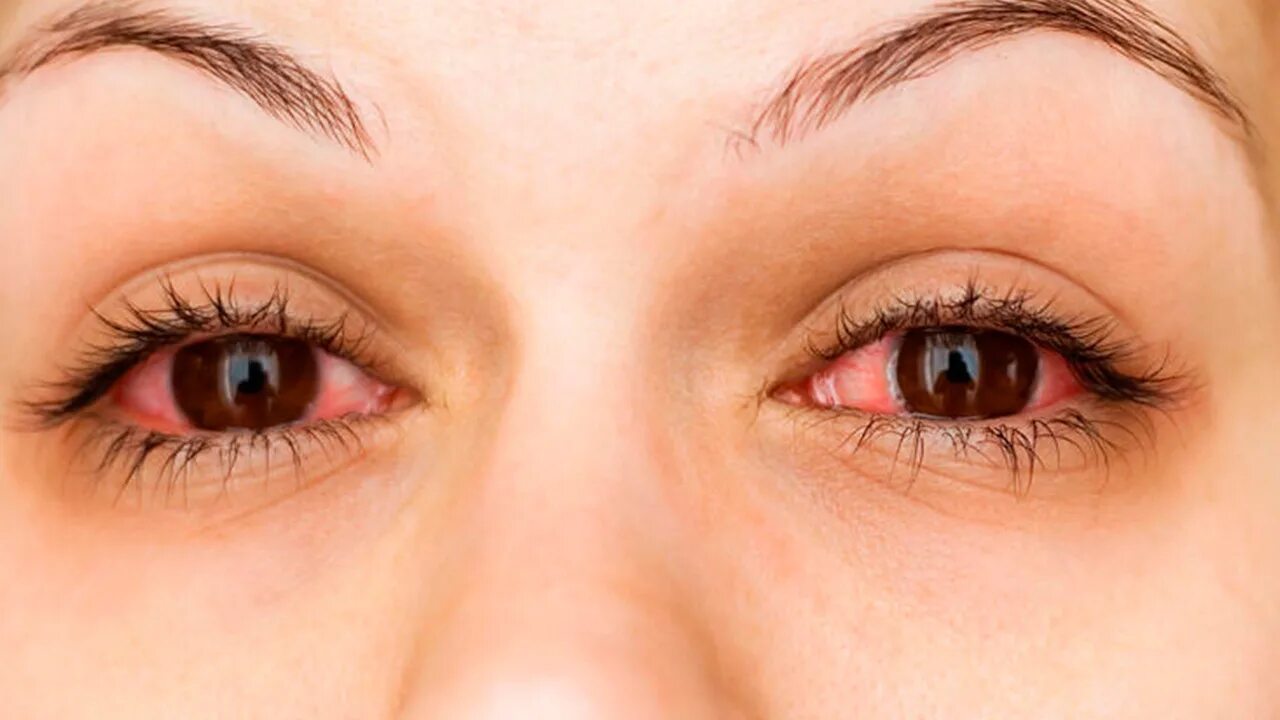 Синяяки и мешочки под глазами. Направит для глаз. Глаза выглядят уставшими. Огромные круги под глазами. Глаза выглядят уставшими.