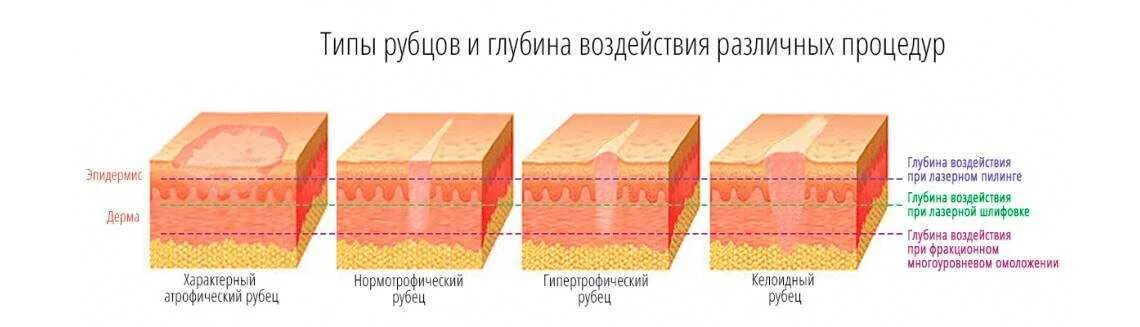 Распад кожи. Лазерная шлифовка рубца этапы заживления. Лазерная шлифовка Рубцовой ткани. Лазерная шлифовка послеоперационного шрама.