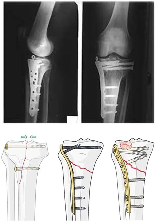 Чрезмыщелковый перелом большеберцовой кости. Перелом мыщелка большеберцовой кости. Стресс перелом большеберцовой кости. Стрессовый перелом большеберцовой кости.