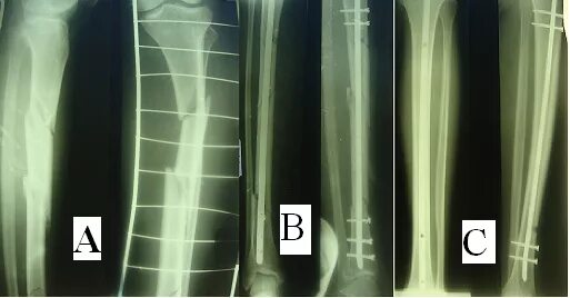 Перелом голени остеосинтез. Накостный остеосинтез голени рентген. Перелом голени рентген остеосинтез. Интермедулярный остеосинтез. Осложнения остеосинтеза