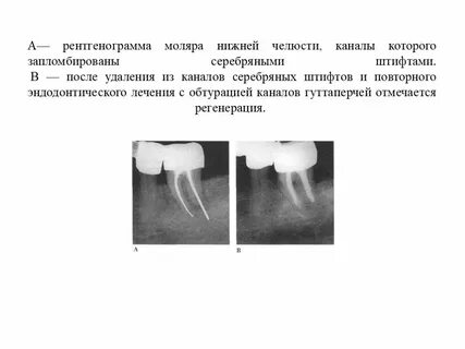 После пломбировки каналов