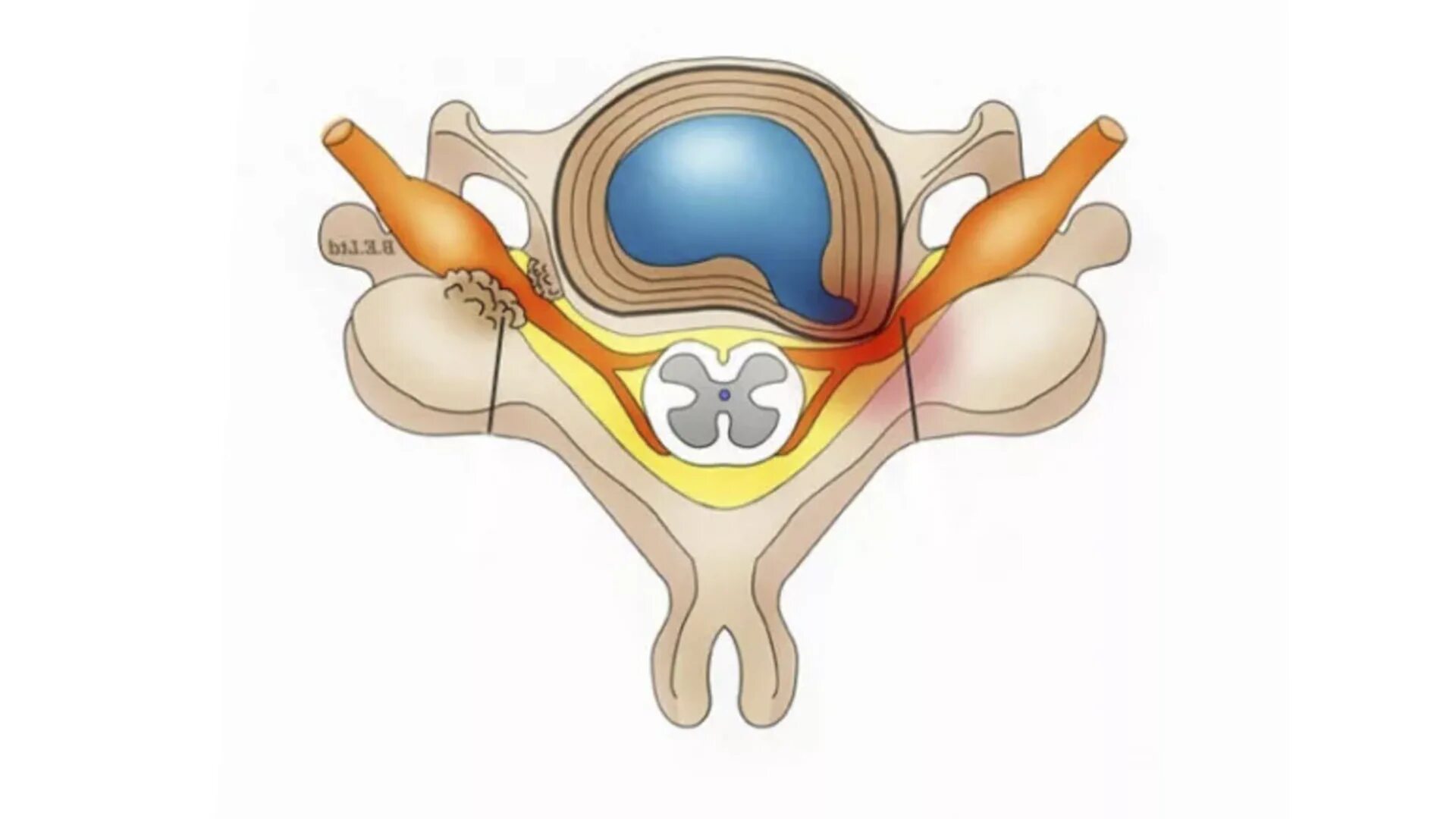 Медианно парамедианная билатеральная. Фораминальная грыжа. Фораминальная грыжа межпозвонкового диска. Правосторонняя парамедианная грыжа. Парамедианная грыжа межпозвонкового диска.