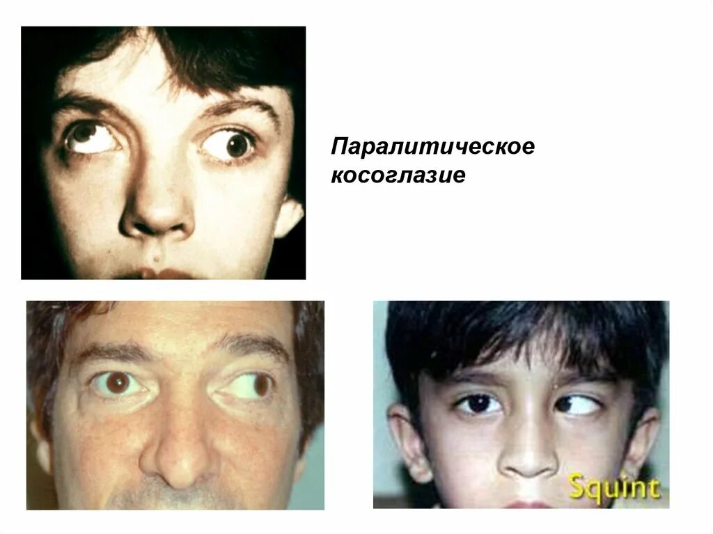 Косоглазие симптомы. Косоглазие. паралитическая косоглазип. паралитическое косоглазие. паралитическое косоглазие у детей.