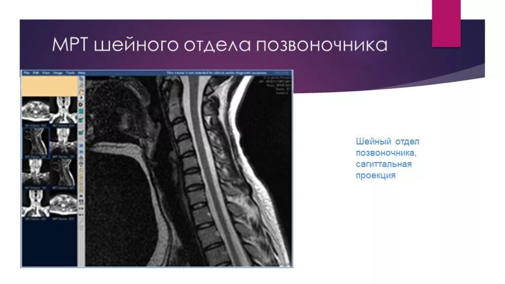 Мрт шейного отдела позвоночника. Нормальное мрт шейного отдела позвоночника. Мрт шейного отдела позвоночника патология. Мрт грудного отдела позвонка.