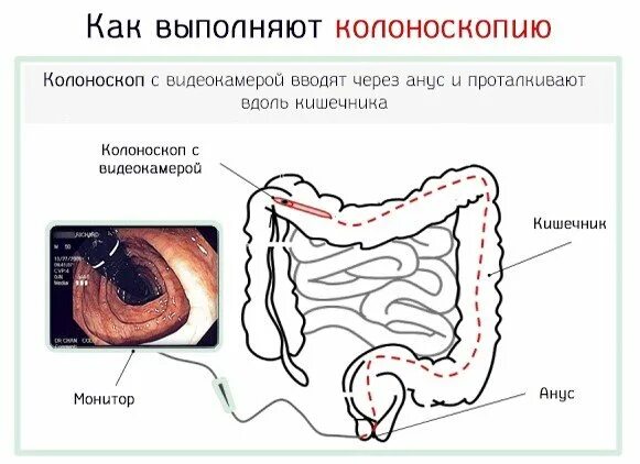 Процедура прямой кишки. Колоноскопия прямой и толстой кишки. колоноскопия толстого кишечника. исследование толстой кишки колоноскопия. колоноскопия кишечника схема.