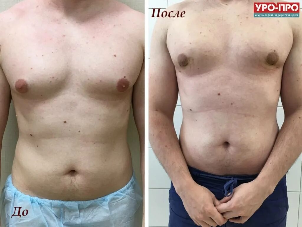 Уменьшение молочных. Уменьшение молочных. Уменьшение молочных. Нормальная грудь у женщины. Маммопластика липофилинг.