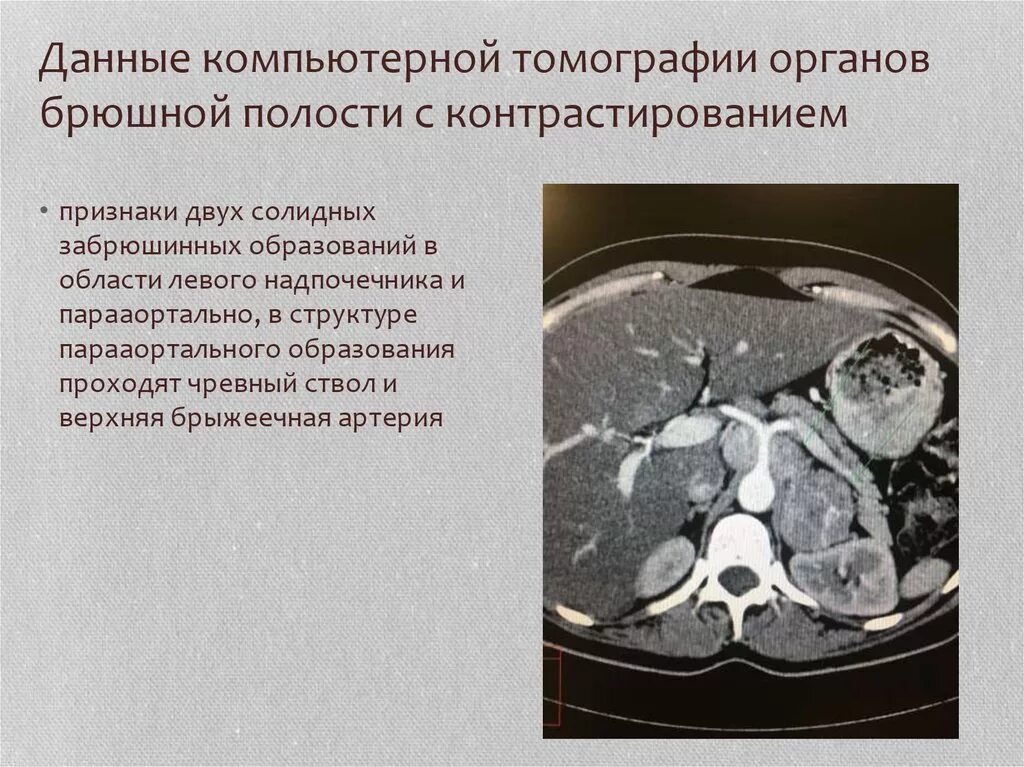 Кт брюшной полости. Компьютерная томография органов брюшной полости. Компьютерная томография органов брюшной полости с контрастированием. Контрастирование при кт брюшной полости.