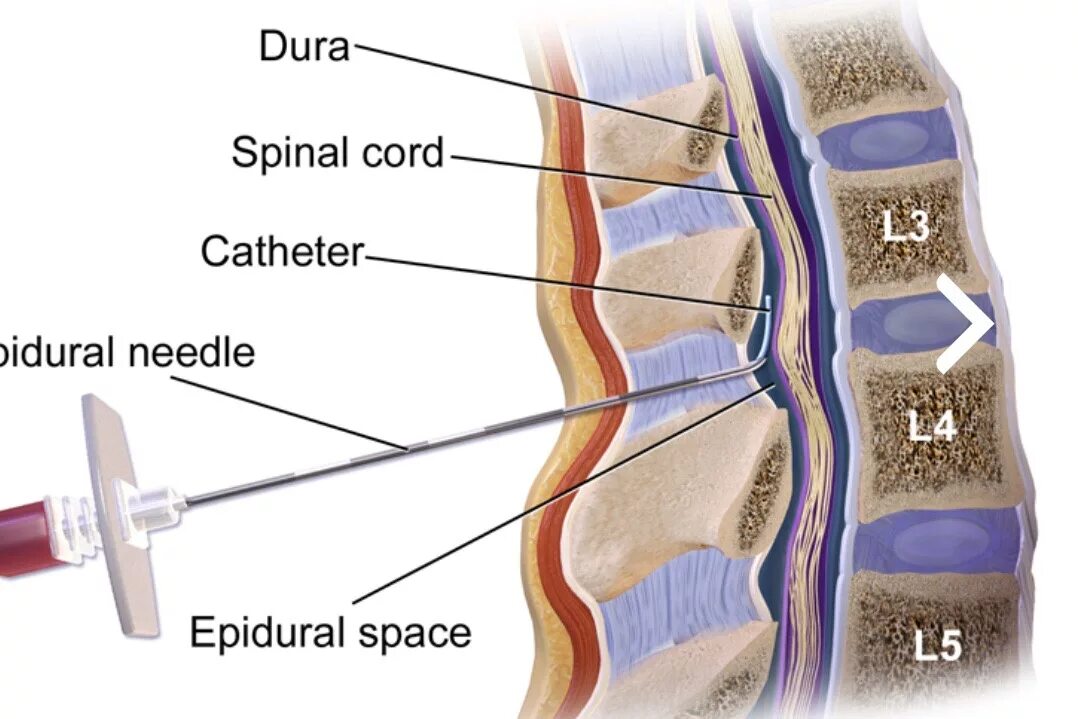 Эпидуралка болит спина. Спинальная анестезия l1-l2. Субарахноидальное пространство для спинальной анестезии. Люмбальная эпидуральная анестезия. Эпидуральная плаката позвоночника.