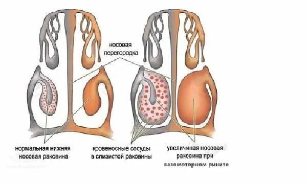 Подслизистой вазотомии нижних раковин. Вазомоторный ринит эндоскопия. Отек нижней носовой раковины. Аллергический ринит вазомоторный ринит. Вазомоторный ринит носовые раковины.