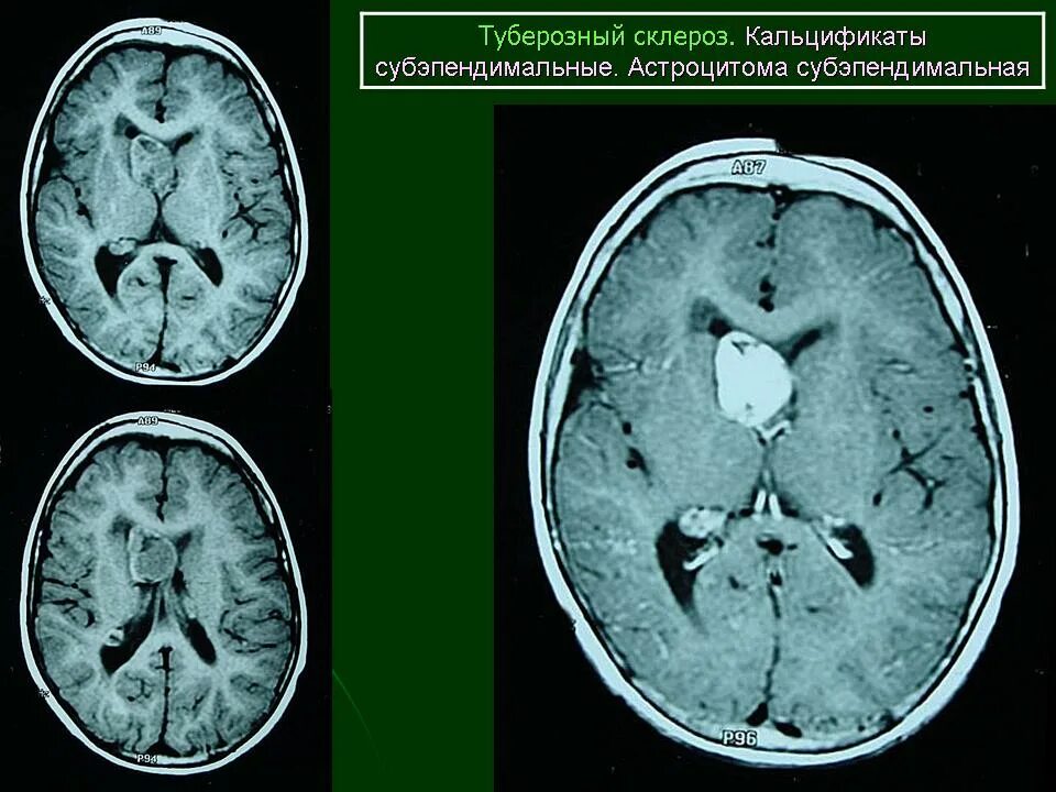 Туберкулезный склероз. Туберкулезный склероз