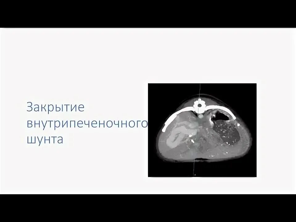 Внутрипеченочный шунт у собак. Печёночный шунт у собак.