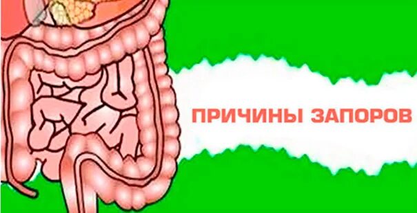 После сильного запора. Причины запора. Запоры кишечник рисунок.