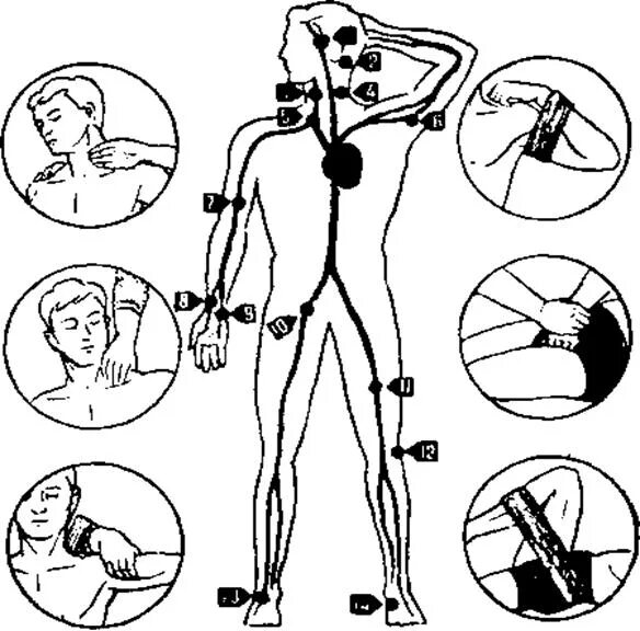 Места прижатия артерий для остановки кровотечения. Место пальцевого прижатия бедренной артерии. Места пальцевого прижатия артерий. Места прижатия артерии верхней конечности.