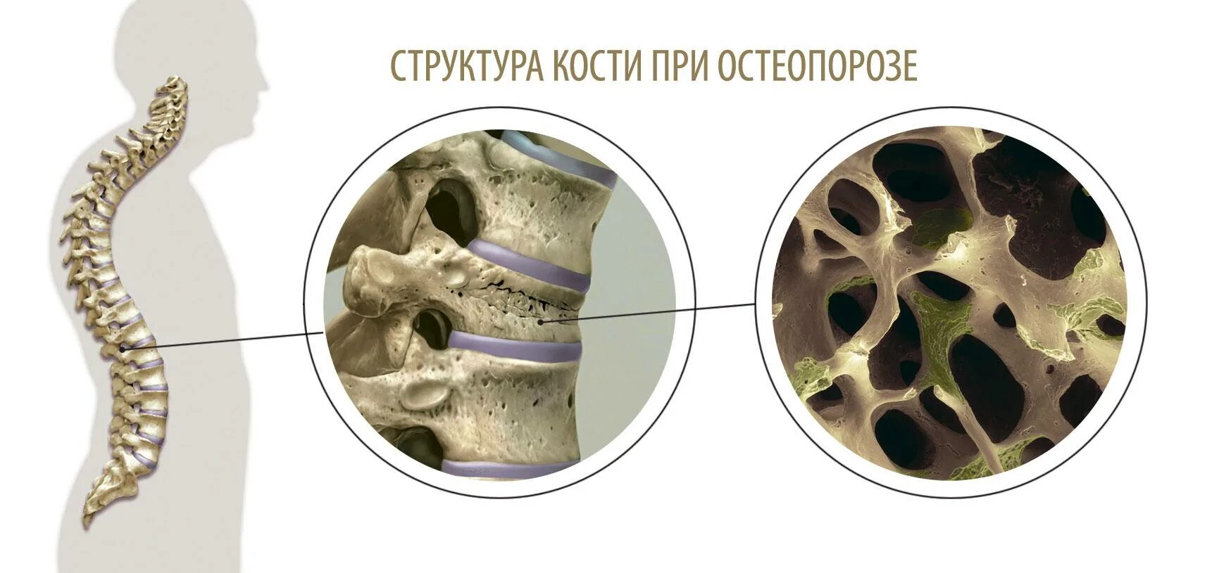 Деструкция кости причины. Патологический перелом бедренной кости метастазы. Остеопороз кость в разрезе. Остеопороз костей позвоночника. Как называется разрушение костей.