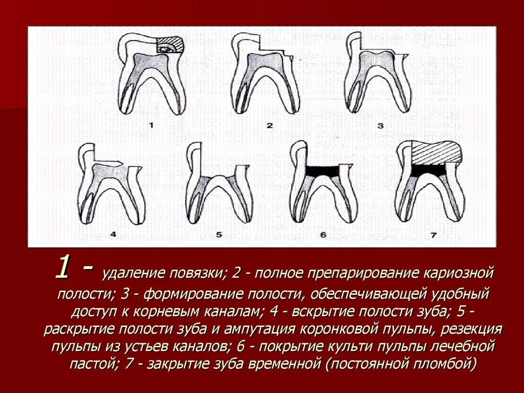 Девитальная экстирпация пульпы. Витальная ампутация пульпита. Девитальной экстирпации пульпы. Ампутация экстирпация пульпы зуба. Осложнения лечения пульпита