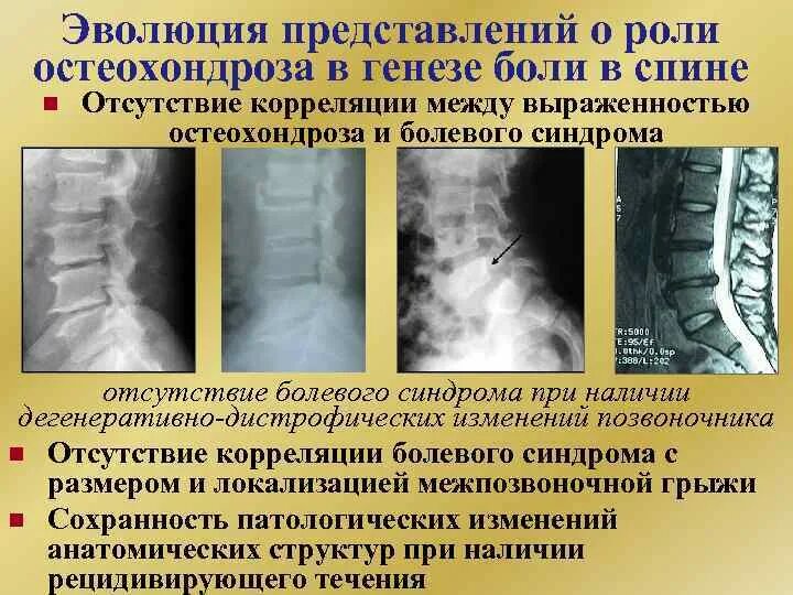 Дистрофические изменения позвоночника. Дегенеративно-дистрофические изменения позвоночника рентген. Дегенеративный стопделит. Дегенеративный спондилит. Умеренные дистрофические изменения грудного отдела позвоночника.