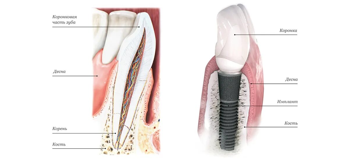 Конструкция дентального имплантата. Строение имплантанта зуба. Строение зубного имплантата. Строение имплантата зуба абатмент.