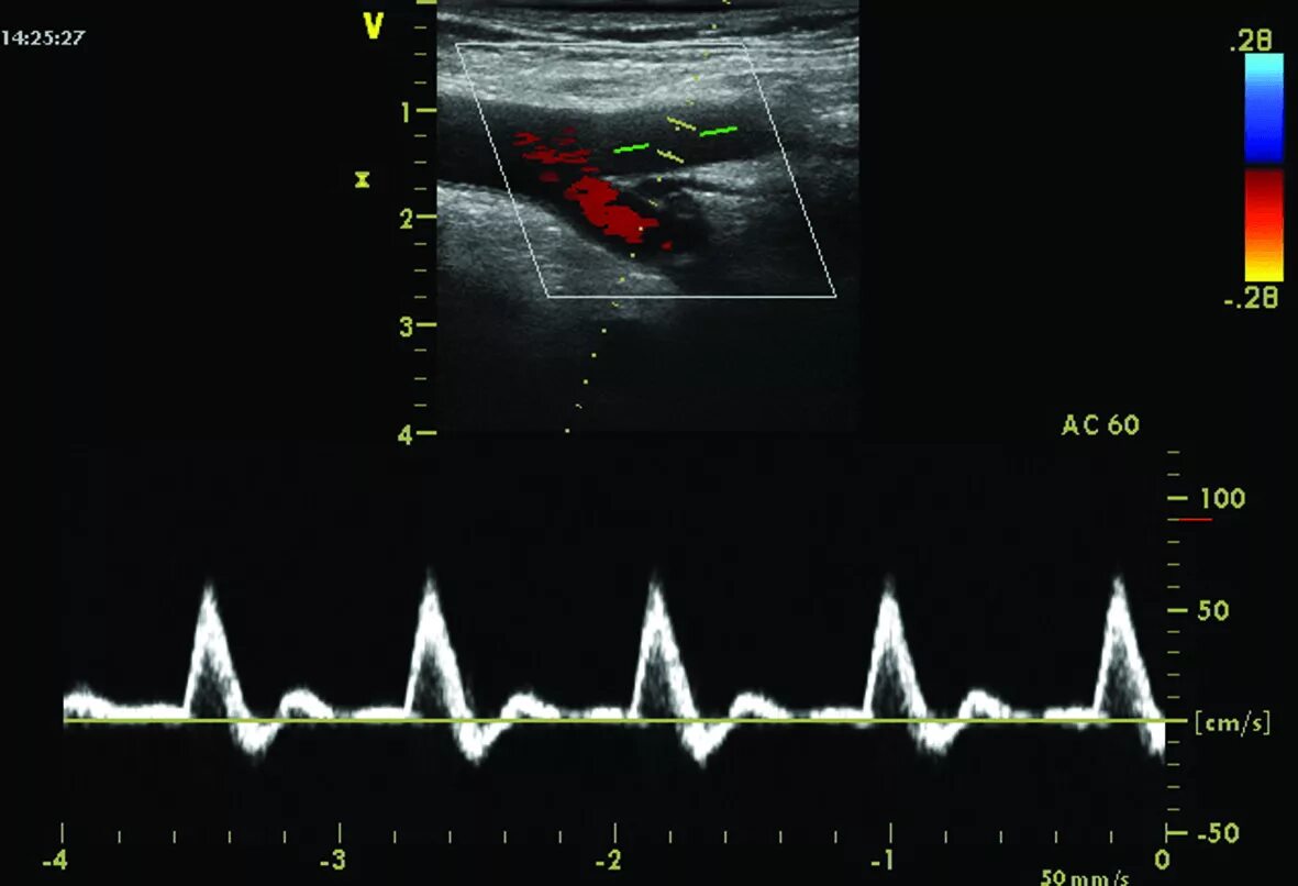 Доплер кровотоки. Допплерография, спектр кровотока. Магистрально измененный Тип кровотока на УЗИ. Магистральный Тип кровотока артерии УЗИ. Магистрально измененный кровоток в артериях нижних конечностей.