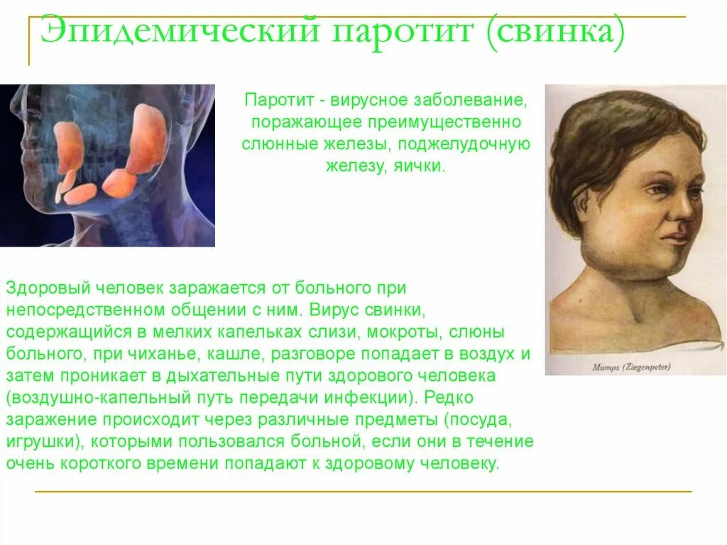 Паратит что это. Заболевание эпид паротит. Свинка эпидемический паротит. Эпидемический паротит симптомы. Эпидемический паротит возбудитель симптомы.