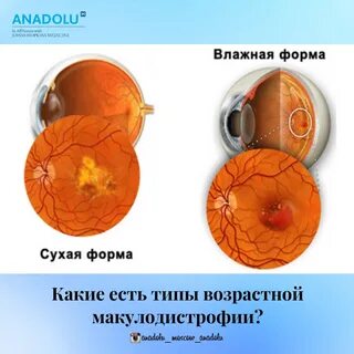 Уколы при дистрофии сетчатки