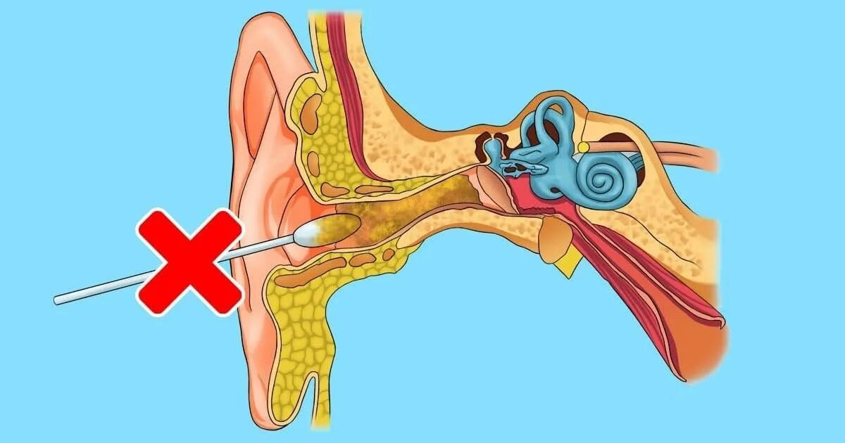 Заложило ухо ватной палочкой что делать. Отомикоз серная пробка. Строение уха серная пробка. Серная пробка ватные палочки. Анатомия уха серная пробка.