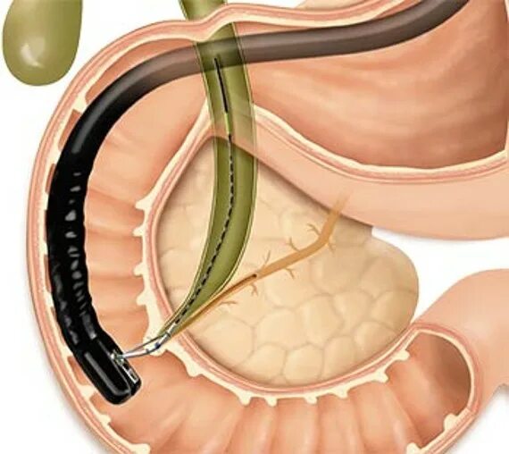 ЭРХПГ желчного протока. Эндоскопическая литоэкстракция. Стент желчного протока