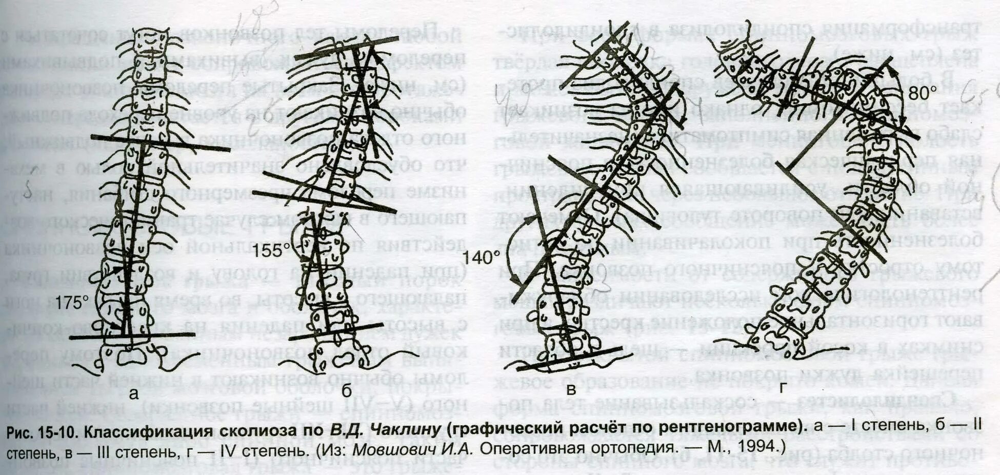 Чаклин классификация сколиоза. Степени сколиоза по чаклину рентген. Классификация сколиоза по в.д. чаклину 1973. Сколиоз по в.д.чаклину. Угол кобба