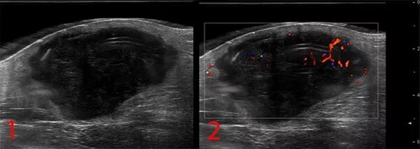 Саркома на узи. Липосаркома УЗИ признаки. Саркома мягких тканей бедра на УЗИ. Фиброма мягких тканей на УЗИ.