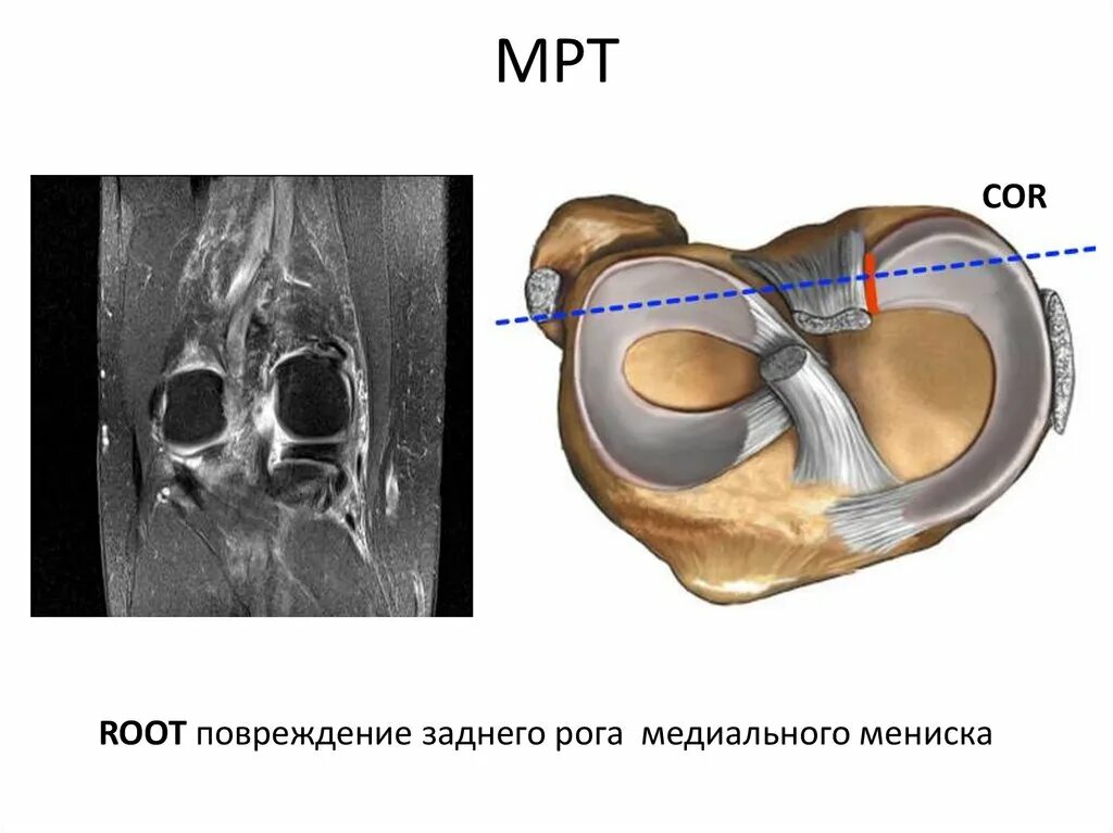 Разрыв рога медиального мениска коленного сустава заднего. Разрыв мениска коленного сустава. Повреждение мениска коленного сустава мрт. Разрыв рога мениска коленного сустава. Разрыв заднего медиального мениска коленного сустава.