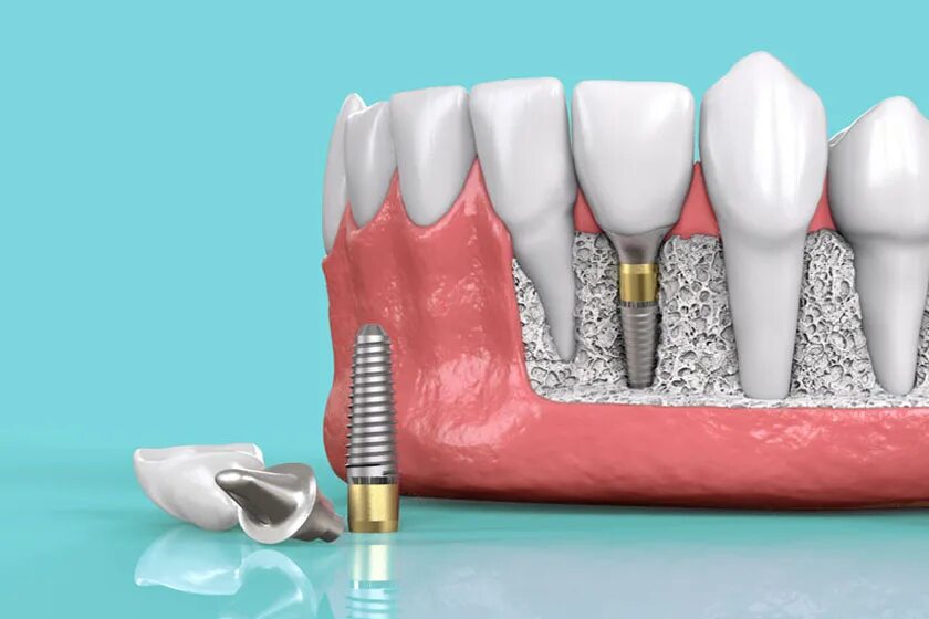Срок импланта. Имплантация osstem. импланты osstem (осстем). имплантаты osstem implant. имплантация (система osstem, корея).