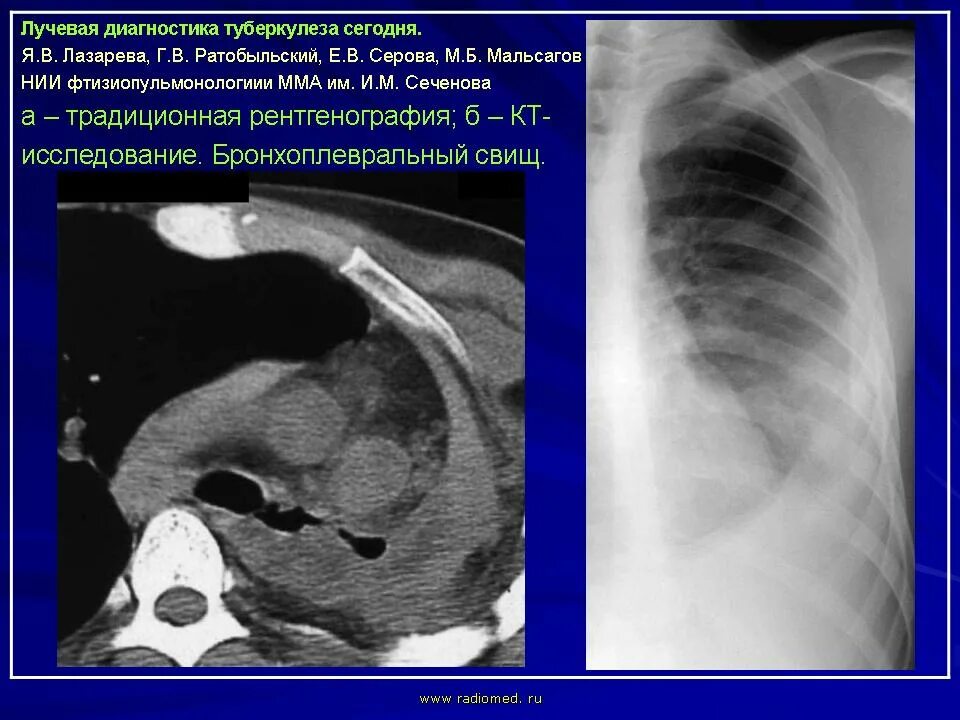 Туберкулез сегодня. Лучевая диагностика туберкулеза. Лучевая диагностика туберкулёза лёгких. Фтизиатрия лучевая диагностика.
