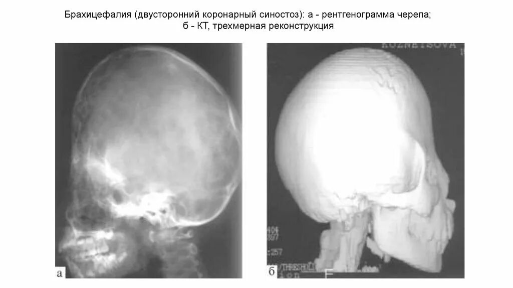 Деформация кости черепа. Плагиоцефалия коронарный синостоз. Синостоз костей черепа. Врожденные аномалии черепа кт. Синостоз костей черепа рентген.